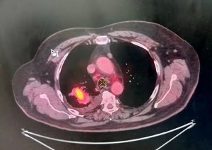 Lung cancer2